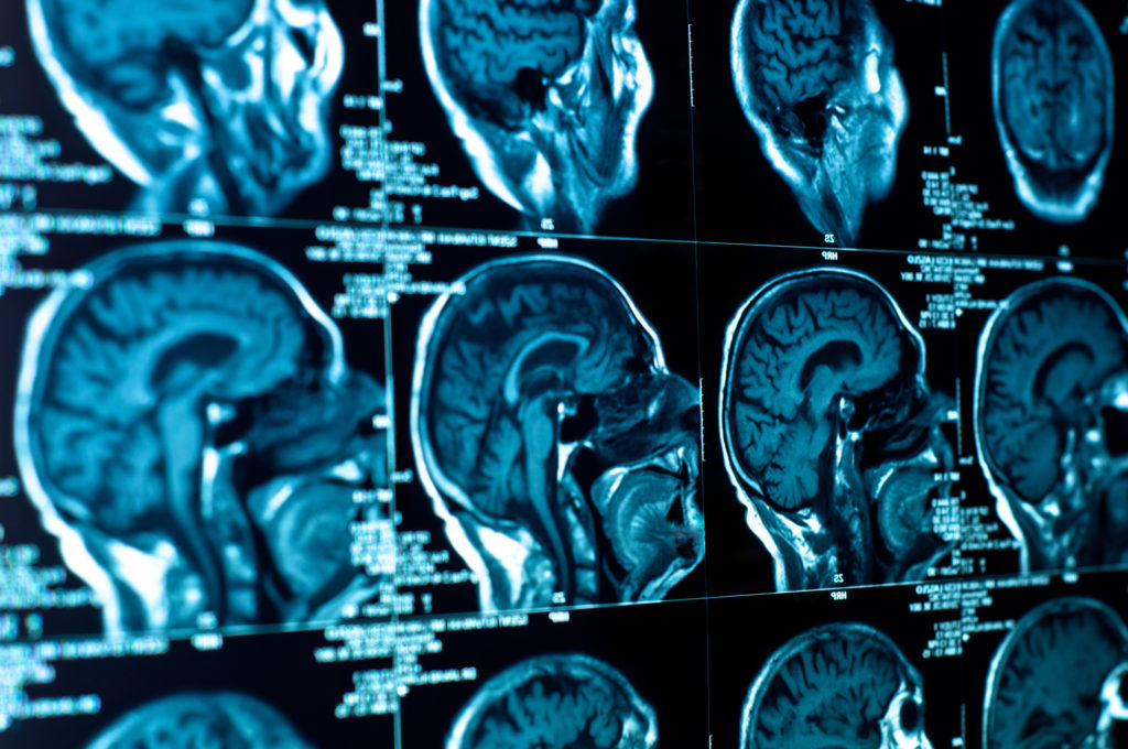 Brain Injury Lawyer San Fernando Valley, CA - Closeup of a CT scan with brain