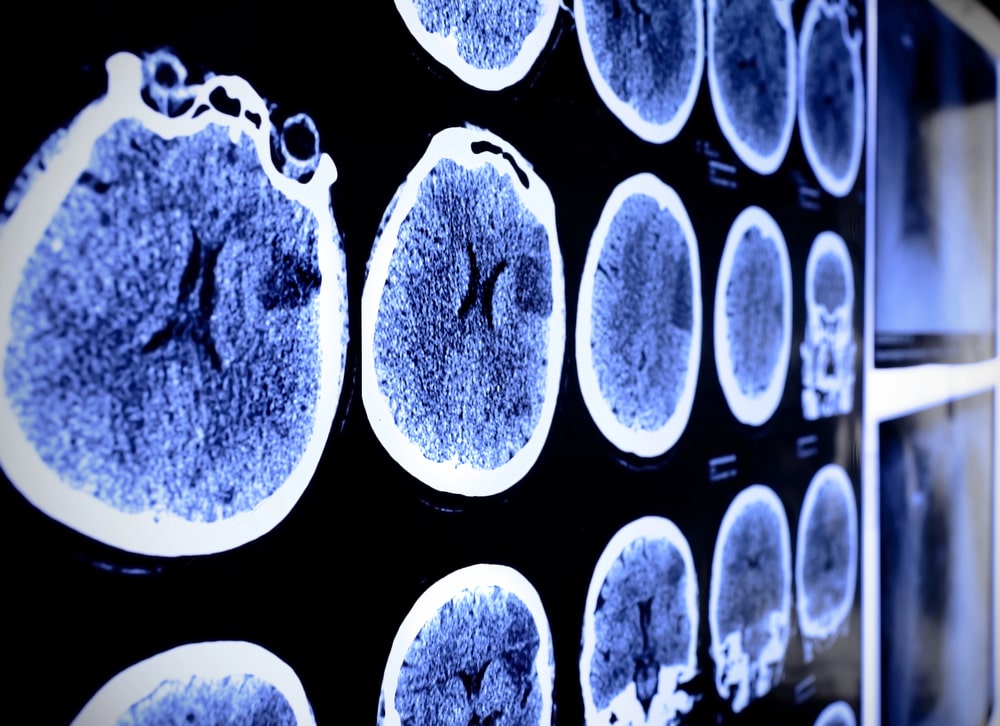 Westlake Village, CA Brain Injury Legal Help After Crash 