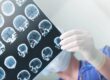 brain injury lawyer San Fernando Valley, CA