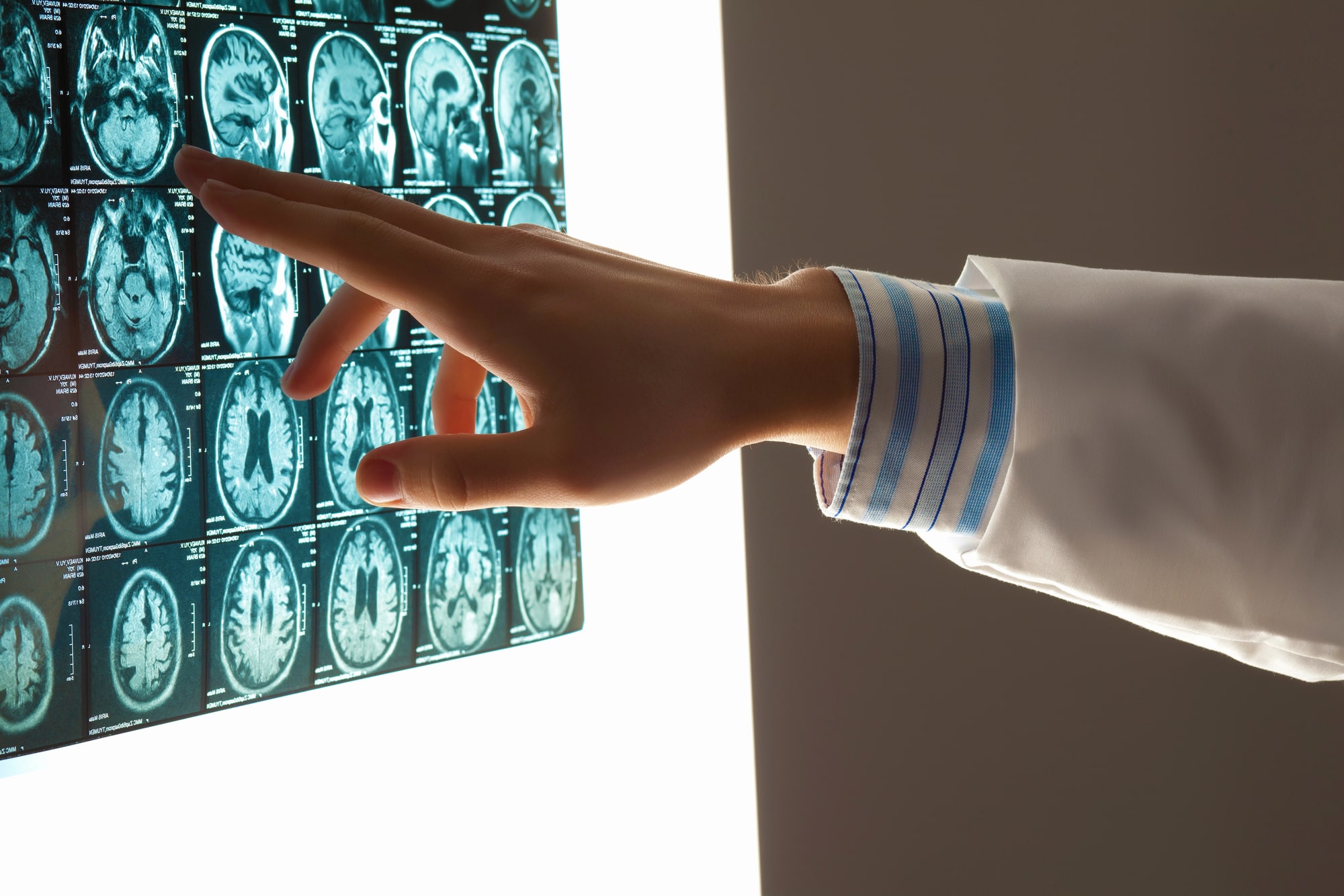 brain injury lawyer Chatsworth, CA