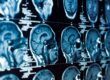 brain injury lawyer Simi Valley, CA