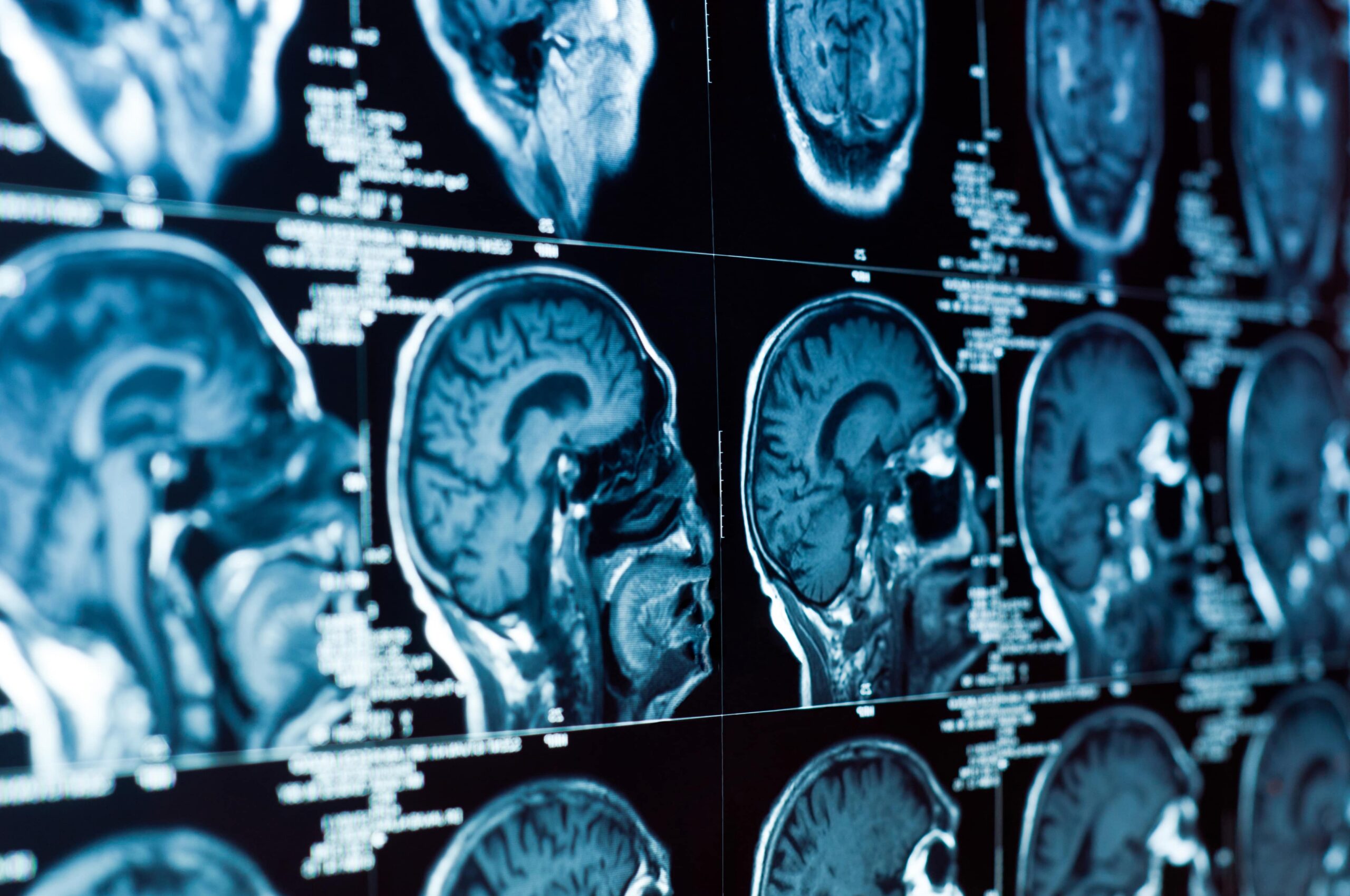brain injury lawyer Simi Valley, CA brain injury lawyer Simi Valley, CA